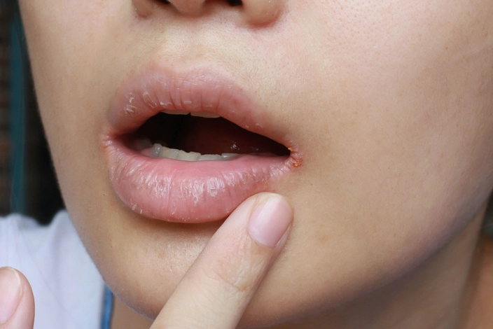Angular cheilitis (credit: Wonderplay on Shutterstock)