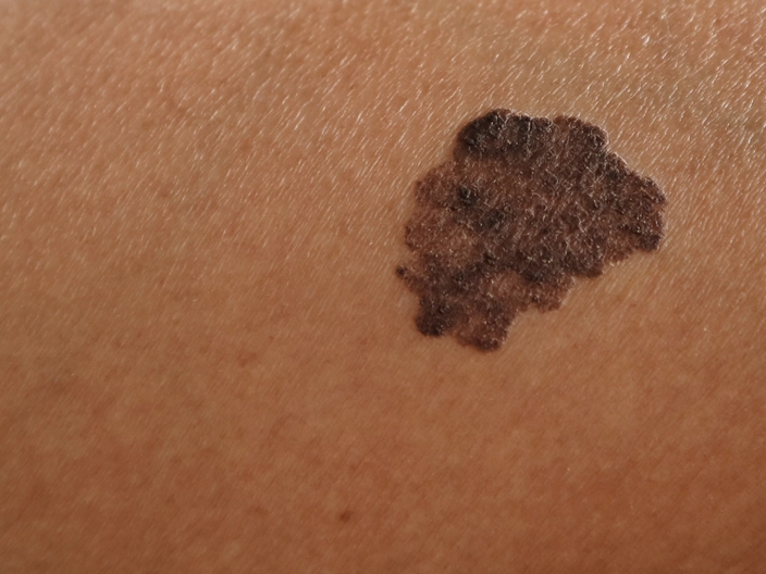 Skin cancer (credit: Octopus16 on Shutterstock)